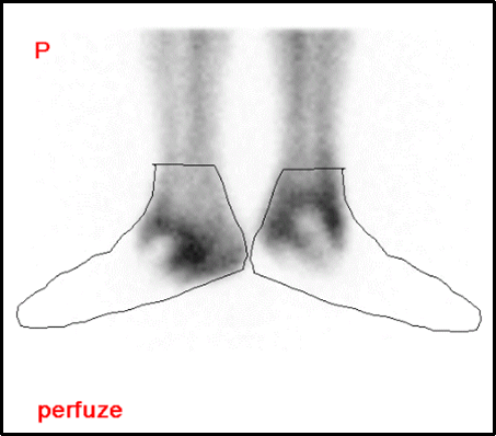 Obr. 3: Projekce nohou vperfzn fzi s orientan vyznaenm obrysem. Perfze tknprst, nrt a proximlnch st tarz chyb.