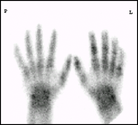 Obr. 6: Projekce rukou, skelet se zobrazuje kompletn, postien odpovd I.  II. stupni.
