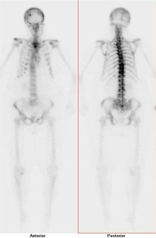 Obr. . 1: Celotlov scintigrafie skeletu v pedn a zadn projekci s nlezem difzn zven a nehomogenn akumulace radiofarmaka v oblasti axilnho skeletu - pevn v hrudn ptei a ebrech, v hrudn kosti, v kalv frontoparietln vpravo. Apendikulrn skelet je zobrazen chab, nejsou zobrazeny ledviny. Nlez odpovd mnohoetn diseminaci malignho onemocnn do skeletu - jedn se o tzv. suprescan.