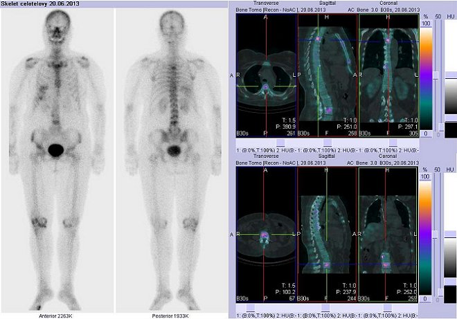 Obr..1: Celotlov scintigrafie v pedn a zadn projekci a fze obraz SPECT a CT.  Vpravo nahoe a dole  zameno na loiska v hrudn a bedern ptei. ezy transverzln, ezy sagitln a ezy koronln.