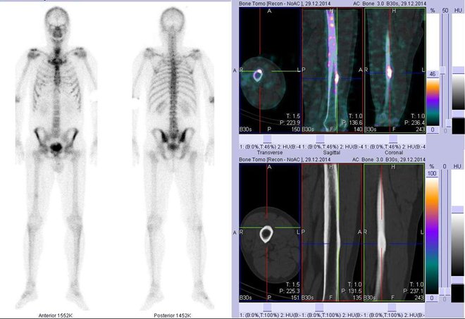 Obr. . 4: Celotlov scintigrafie v pedn a zadn projekci a fze obraz SPECT a CT. Vpravo zameno na loisko ve ventrln sti prav kosti stehenn  vpravo nahoe fze obraz SPECT a CT, vpravo dole CT. Vpravo ezy transverzln, ezy sagitln a ezy koronln.