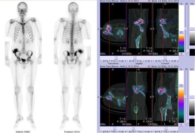 Obr.1: Celotlov scintigrafie v pedn a zadn projekci a fze obraz SPECT a CT. Vpravo fze obraz SPECT a CT - zameno na loisko v laterokraniln sti lopaty prav kosti kyeln. Vpravo ezy transverzln, ezy sagitln a ezy koronln.
