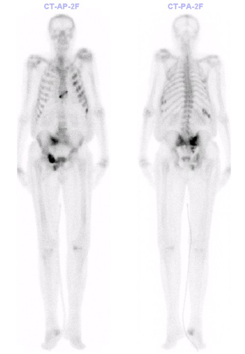 Obr. . 2: Celotlov tfzov scintigrafie skeletu v kostn fzi.