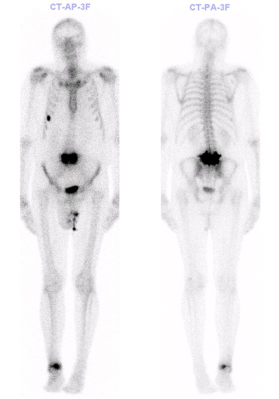 Obr. . 4: Celotlov tfzov scintigrafie skeletu v kostn fzi.