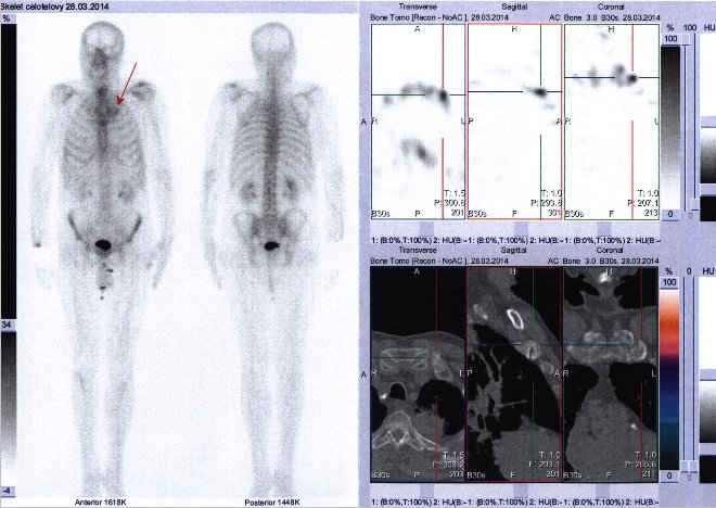Obr..1: Celotlov scintigrafie vpedn a zadn projekci a fze obraz SPECT a CT.  Vpravo zameno na hrudnk. ezy transverzln, sagitln a koronrn.