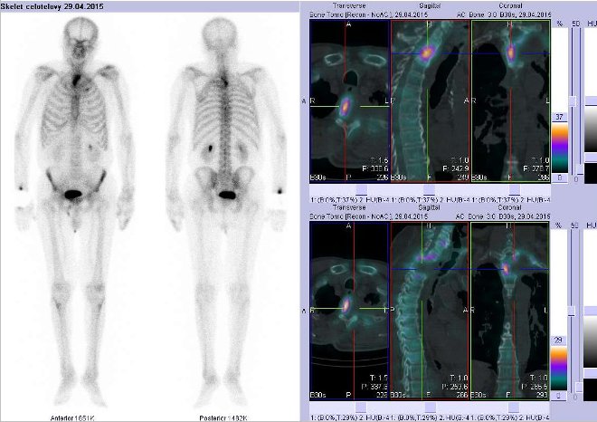 Obr..3: Celotlov scintigrafie vpedn a zadn projekci a fze obraz SPECT a CT.  Vpravo zameno na obratel Th3-4. ezy transverzln, sagitln a koronrn.
