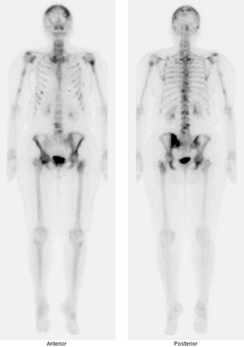 Obr. č. 1 – Celotělová scintigrafie skeletu v přední a zadní projekci