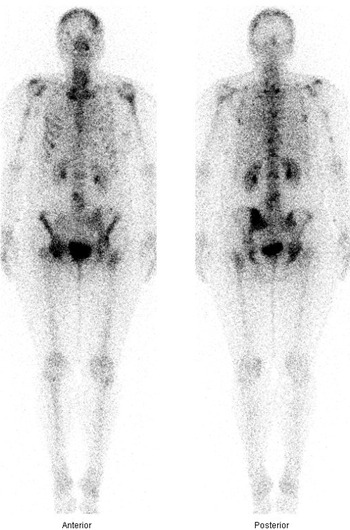 Obr. . 2  celotlov scintigramy v pedn a zadn projekci 3 hodiny po aplikaci rhenia
