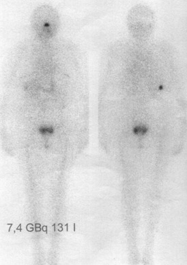 Obr. . 1: Celotlov scintigrafie 4 dny po podn 7,4 GBq 131I - pedn a zadn projekce 11/06