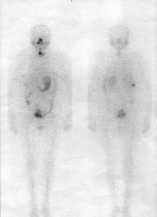 Obr. . 2: Celotlov scintigrafie 4 dny po podn 7,4 GBq 131I - pedn a zadn projekce 11/04