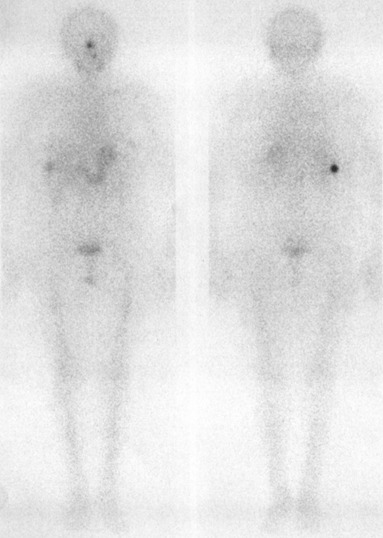 Obr. . 5: Celotlov scintigrafie 5 dn po podn 7,4 GBq 131I - pedn a zadn projekce 1/06