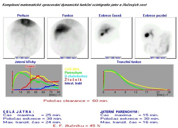Obr. . 6: Cholescintigrafie  dynamick scintigrafie 8/07