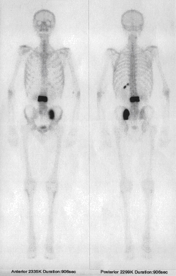 Obr. č. 1 – Celotělové scintigrafie skeletu v přední a zadní projekci
