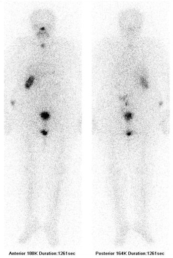 Obr. . 1: Celotlov scintigrafie 4 dny po podn 7,4 GBq 131I - pedn a zadn projekce