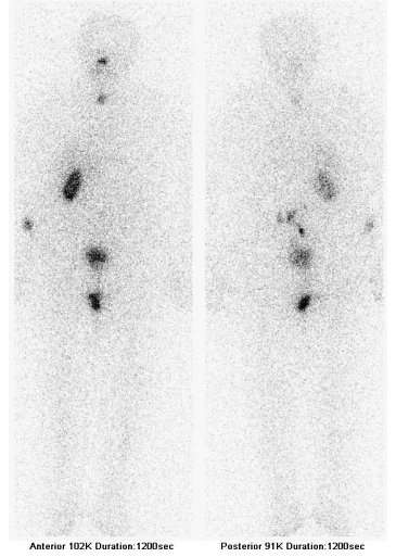 Obr. . 2: Celotlov scintigrafie 5 dn po podn 7,4 GBq 131I - pedn a zadn projekce