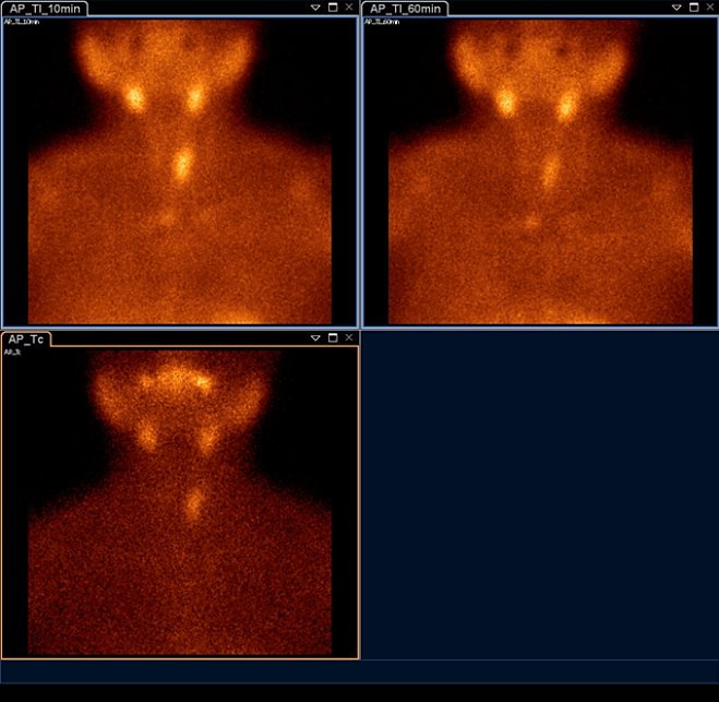 Obr.2.: Planární scintigrafie v AP projekci pomocí 99mTc-pertechnetátu (vlevo dole) a 99mTc-MIBI (1. fáze vlevo nahoře, 2. vpravo nahoře) se zřetelnou akumulací MIBI v mediastinu a zpomaleným vyplavováním.