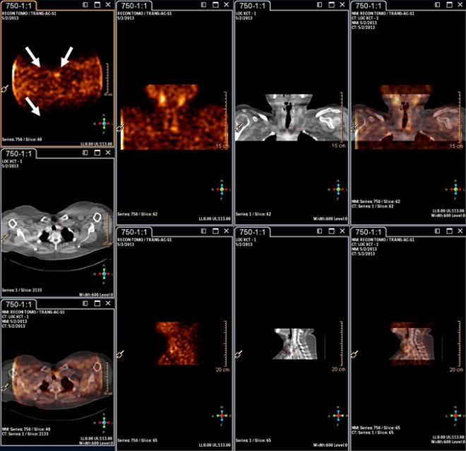 Obr.3.: Scintigrafie pomocí 99mTc-MIBI metodou SPECT/CT  se zřetelnou patologickou ložiskovou depozicí radiofarmaka v blízkosti dolního pólu levého laloku štítné žlázy.