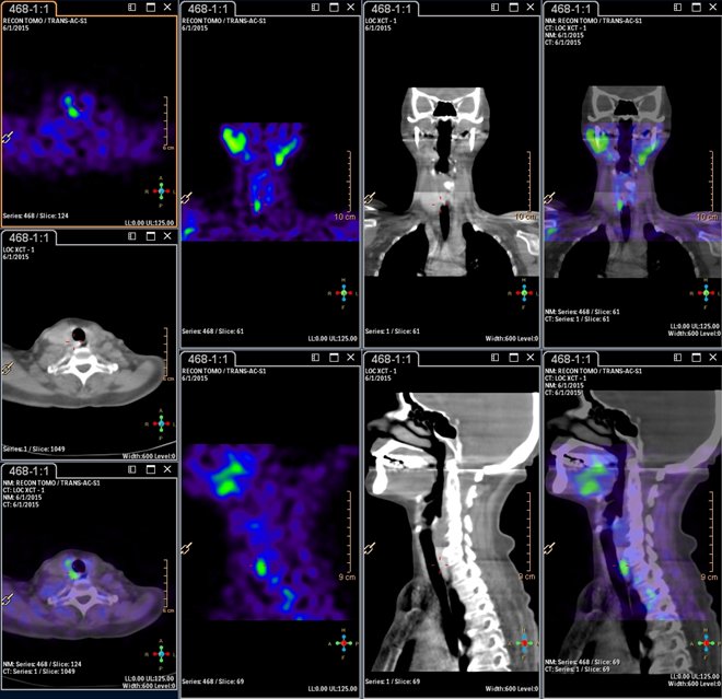 Obr.3.: Scintigrafie pomocí 99mTc-MIBI metodou SPECT/ldCT se zřetelnou patologickou ložiskovou depozicí radiofarmaka atypicky lokalizovanou při pravém dorzolaterálním okraji průdušnice.