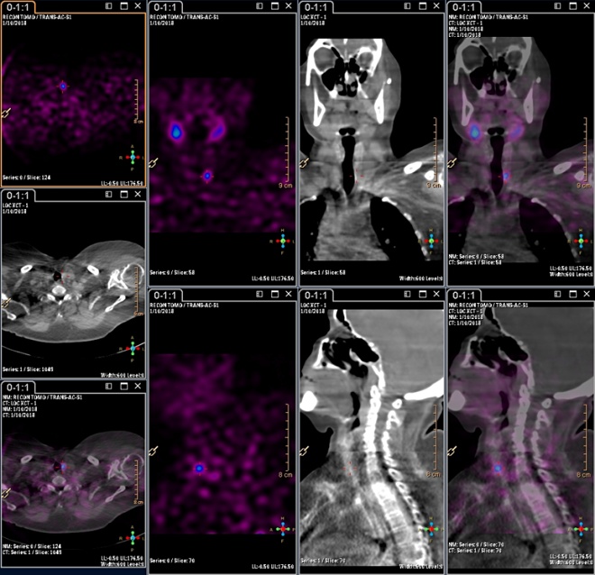 Obr.3.:Scintigrafie pomoc 99mTc-MIBI metodou SPECT/ldCT
