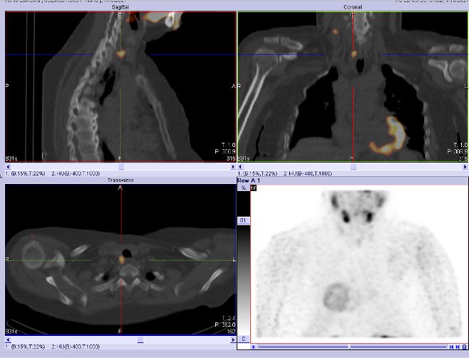 Obr.2.: Scintigrafie pomocí 99mTc-MIBI metodou SPECT/ldCT  se zřetelnou patologickou ložiskovou depozicí radiofarmaka  lokalizovanou  dorzálně od dolního pólu pravého laloku štítnice.