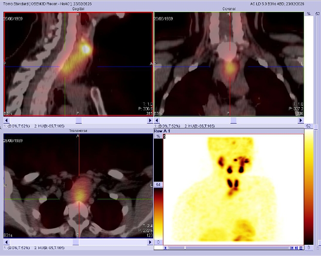 Obr.2.: Scintigrafie pomocí 99mTc-MIBI metodou SPECT/ldCT se zřetelnou patologickou ložiskovou depozicí radiofarmaka lokalizovanou dorzokaudálně od dolního pólu levého laloku štítnice.