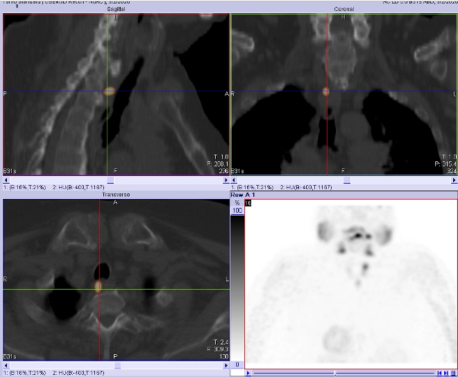 Obr.2.: Scintigrafie pomocí 99mTc-MIBI metodou SPECT/ldCT se zřetelnou patologickou ložiskovou depozicí radiofarmaka lokalizovanou dorzomediálně od horního pólu pravého laloku štítnice (mezi tracheou a páteří).