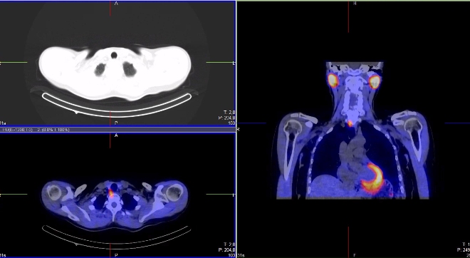 Obr.2.: Scintigrafie pomocí 99mTc-MIBI metodou SPECT/ldCT se zřetelnou patologickou ložiskovou depozicí radiofarmaka lokalizovanou dorzomediálně od dolního pólu pravého laloku štítnice (mezi tracheou a páteří).
