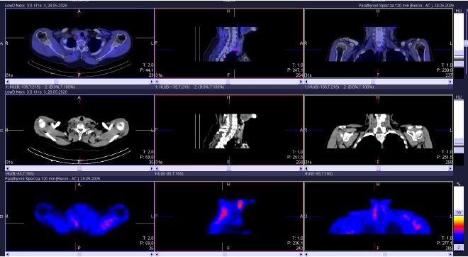 Obr.2.: Scintigrafie pomocí 99mTc-MIBI metodou SPECT/ldCT se zřetelnou patologickou ložiskovou depozicí radiofarmaka lokalizovanou dorzálně od dolního pólu pravého laloku štítnice (mezi tracheou a páteří)
