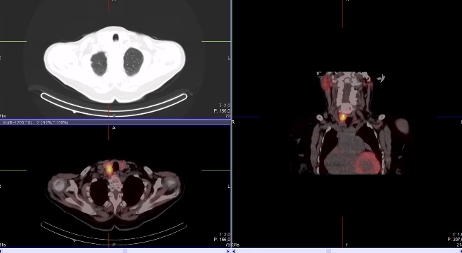 Obr.2.: Scintigrafie pomocí 99mTc-MIBI metodou SPECT/ldCT se zřetelnou patologickou ložiskovou depozicí radiofarmaka lokalizovanou dorzálně od dolního pólu pravého laloku štítnice.