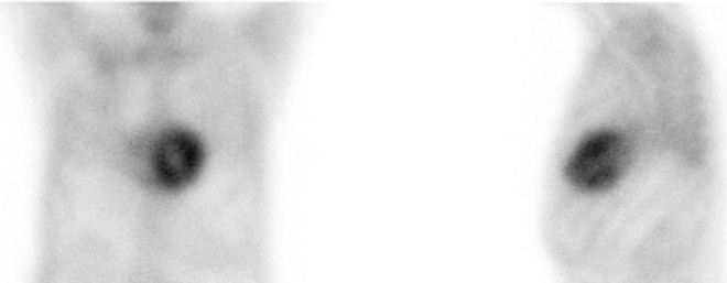 Obr.1: Statick� scintigrafie hrudn�ku v p�edn� a lev� bo�n� projekci. Vy�et�en� 3 hodiny po aplikaci radiofarmaka.