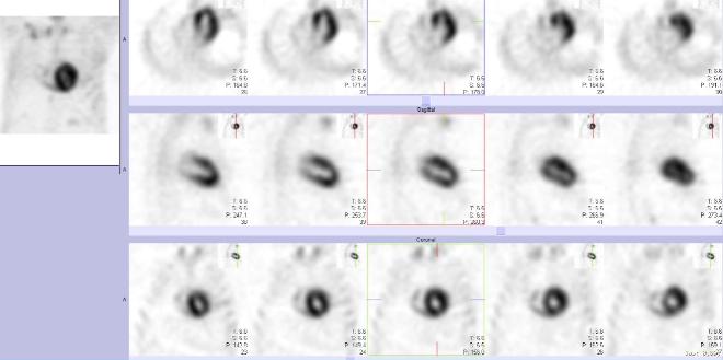 Obr.�.2: Tomografick� scintigrafie myokardu.