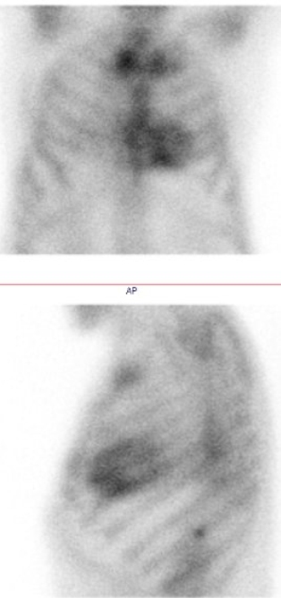 Obr. �. 1: Statick� scintigrafie hrudn�ku v p�edn� a lev� bo�n� projekci. Vy�et�en� 3 hodiny po aplikaci radiofarmaka.