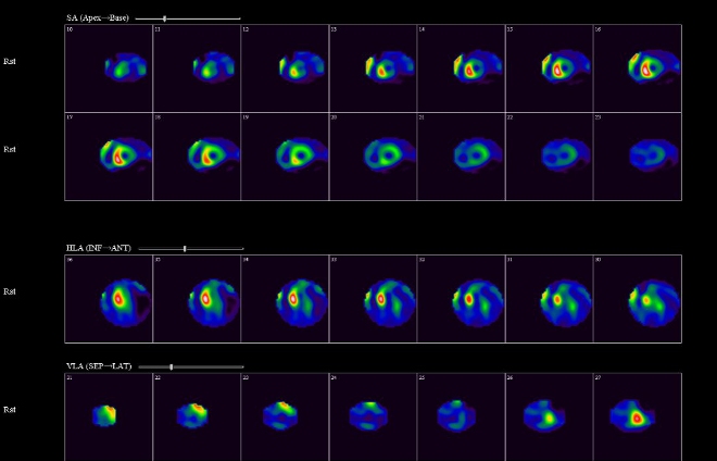 Obr. �. 2: Tomografick� scintigrafie myokardu.