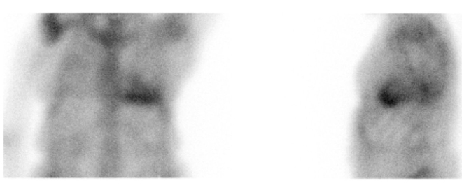Obr.1: Statick� scintigrafie hrudn�ku v p�edn� a lev� bo�n� projekci. Vy�et�en� 3 hodiny po aplikaci radiofarmaka.