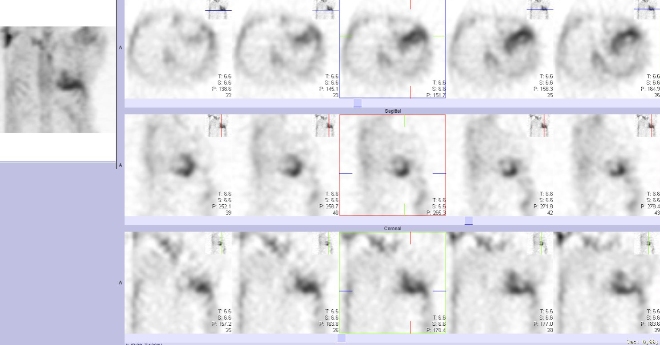 Obr.�.2: Tomografick� scintigrafie myokardu.