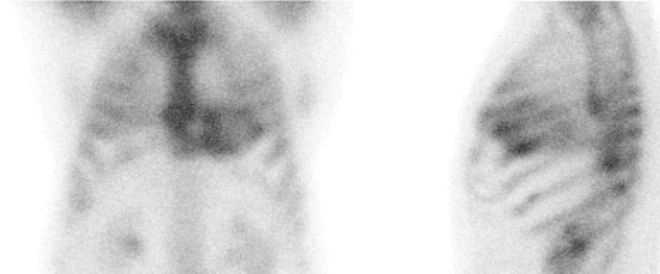 Obr.1: Statick� scintigrafie hrudn�ku v p�edn� a lev� bo�n� projekci. Vy�et�en� 3 hodiny po aplikaci radiofarmaka.