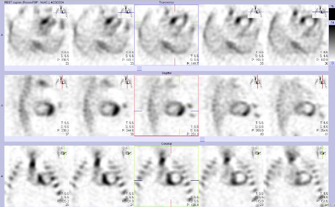 Obr.�.2: Gatovan� tomografick� scintigrafie myokardu.
