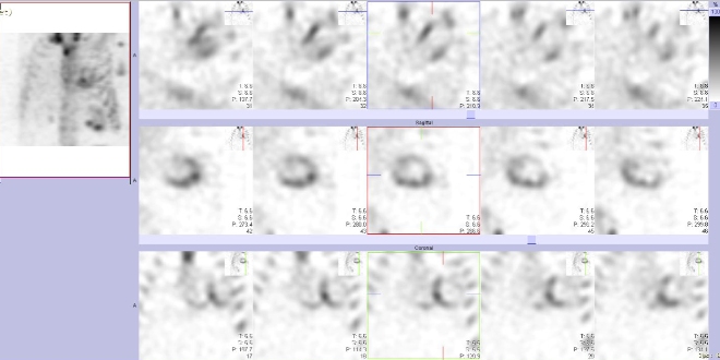 Obr.�.2: Gatovan� tomografick� scintigrafie myokardu.