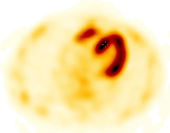 Obr. 4: SPECT, koron�rn� �ez.