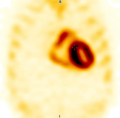 Obr. 5: SPECT, sagit�ln� �ez.