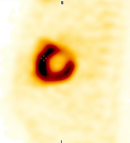 Obr. 6: SPECT, 3D rekonstrukce.