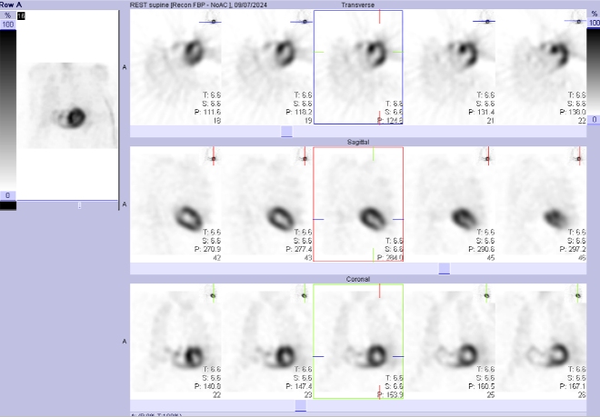Obr.�.2: Gatovan� tomografick� scintigrafie myokardu.