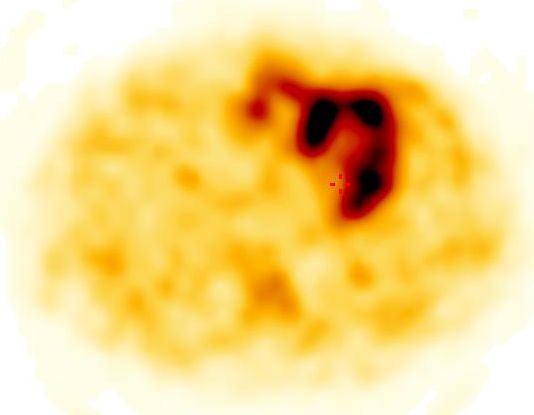 Obr. 3: SPECT, transverz�ln� �ez.