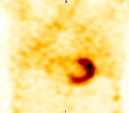 Obr. 4: SPECT, koron�rn� �ez.