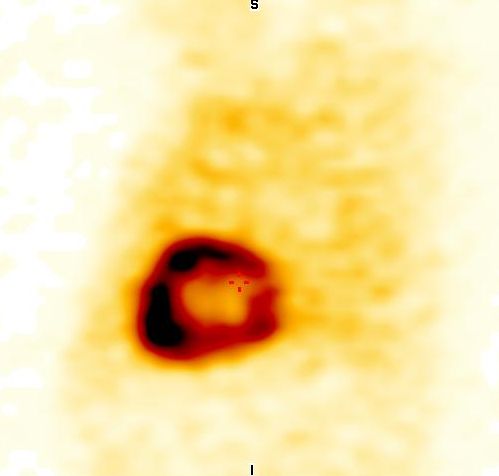 Obr. 5: SPECT, sagit�ln� �ez.