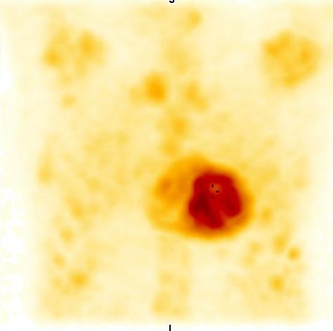 Obr. 6: SPECT, 3D rekonstrukce.