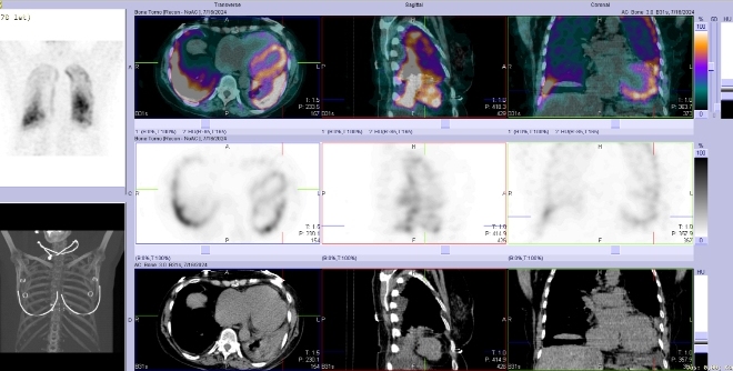 Obr. č. 4-5: SPECT/CT hrudníku. Vyšetření 3,5 hodiny po aplikaci radiofarmaka.