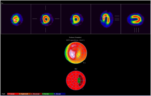 Obr. �. 2: Gatovan� tomografick� scintigrafie myokardu.
