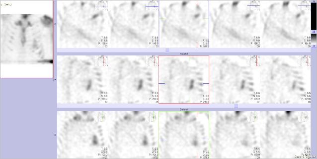 Obr.�.2: Gatovan� tomografick� scintigrafie myokardu.
