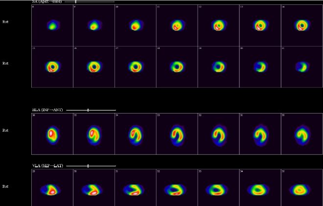 Obr. �. 2: Gatovan� tomografick� scintigrafie myokardu.